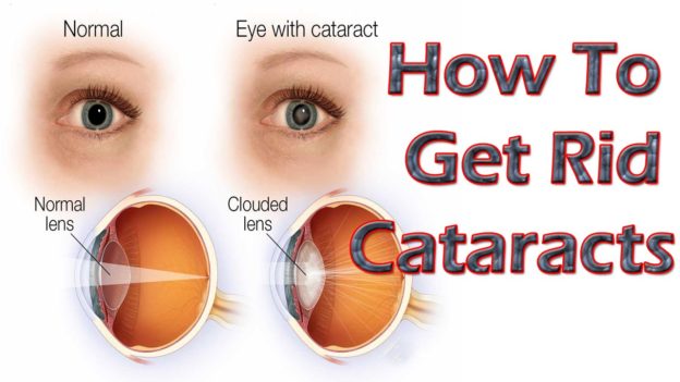 What is Eye Cataracts – Prevention, Sign of Symptoms, Treatment