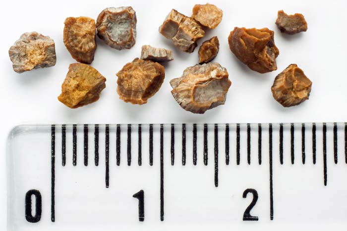 Foods to Eat and Avoid When You Have Kidney Stones