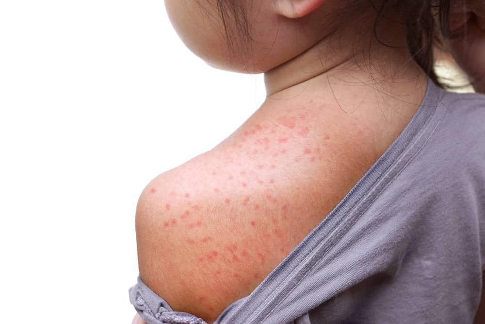 Allergic Reaction In Children Treatment And Care Origin Of Idea