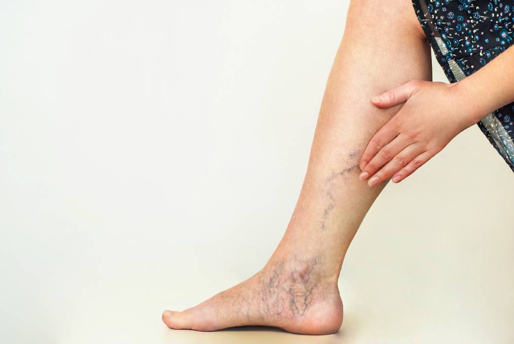 Varicose Veins: 3 Simple Tips to Treat at Home