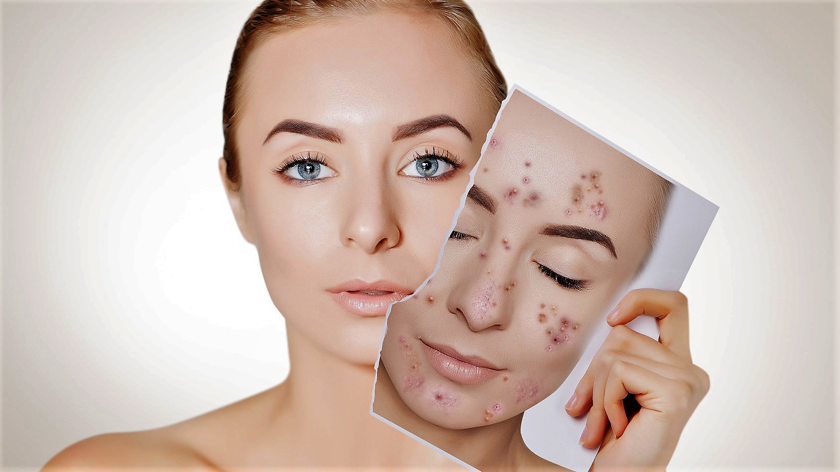 How to Get Rid of Acne: 8 Proven Ways to Fight Acne