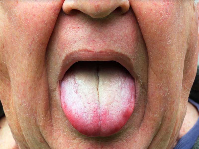 White Tongue Causes & 11 Natural Remedies to Make It Healthier