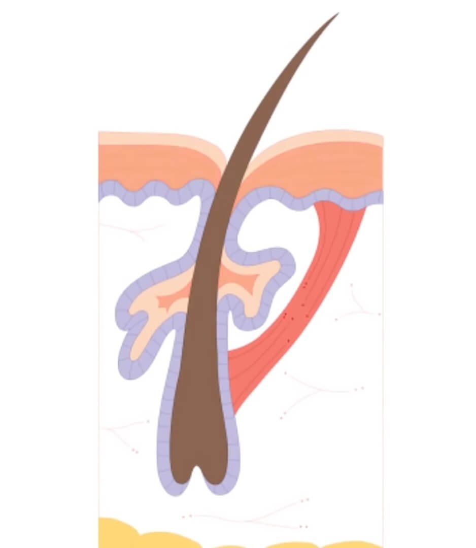 Papules Acne The Insider's Guide to Treat It Naturally Origin Of Idea