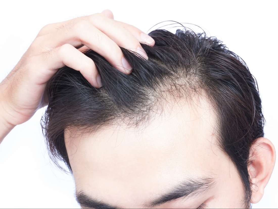 Is It Really Possible to Regrow Lost Hair? (With Treatment)