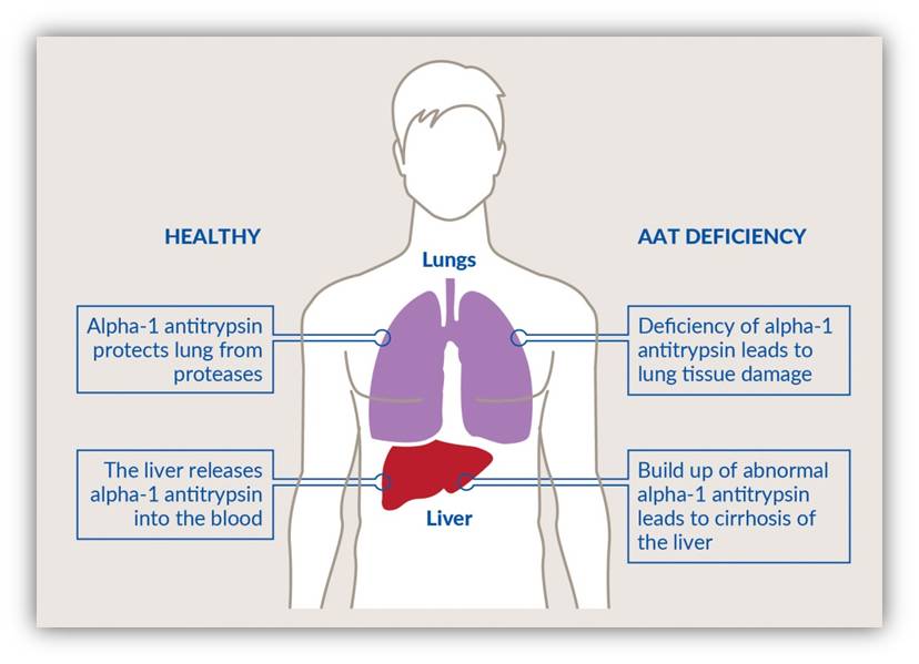 Your Guide To Alpha-1 Antitrypsin (AAT) Deficiency